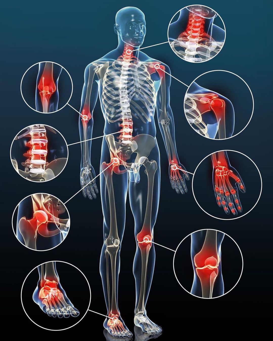 Viêm Cơ Xương Khớp Không Còn Là Bệnh Của Tuổi Già