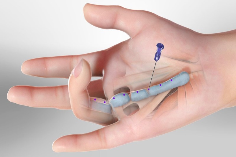 Ngón tay co cứng – Dấu hiệu cảnh báo bệnh xương khớp