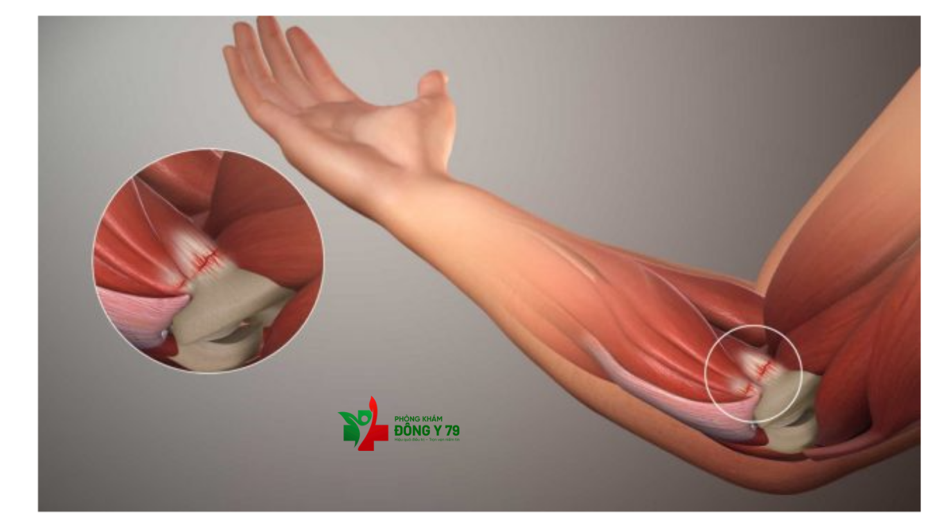 Hết Lo Đau Khớp Khuỷu Tay Nhờ Phương Pháp Phục Hồi An Toàn