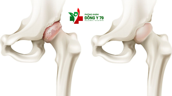 Giải Mã Nguyên Nhân Cơn Đau Chỏm Xương Đùi