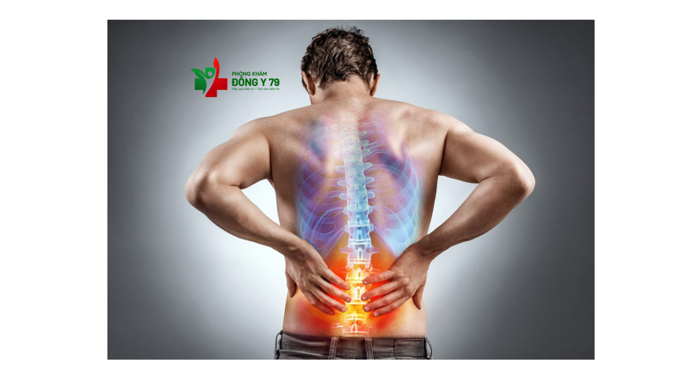 Biến Chứng Nguy Hiểm Của Đau Thần Kinh Tọa: Cảnh Báo Không Nên Chủ Quan